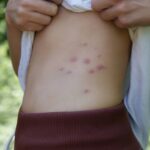 Tout ce qu’il faut savoir sur l’impact des punaises de lit sur la santé